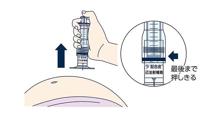 プランジャーを最後まで押しきり、薬液を全量注入したことを確認した後に、注射針を刺した角度と同じ角度で抜きます。